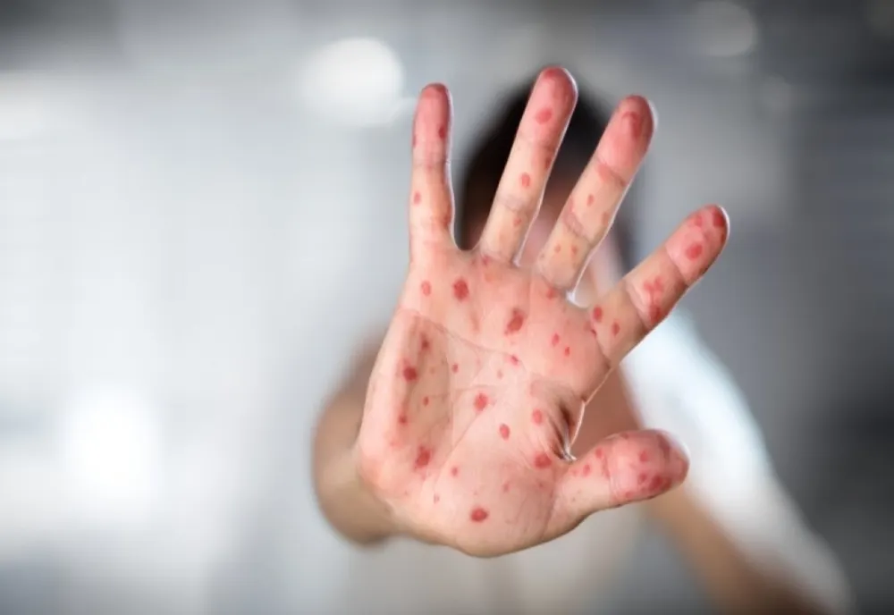 Zeci de cazuri noi de rujeolă au fost confirmate în ultima săptămână