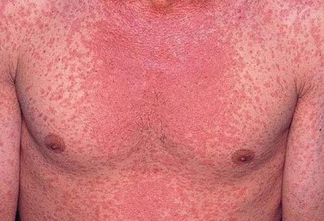 A apărut primul caz de rujeolă în Sălaj! Este vorba de un copil din mediul rural