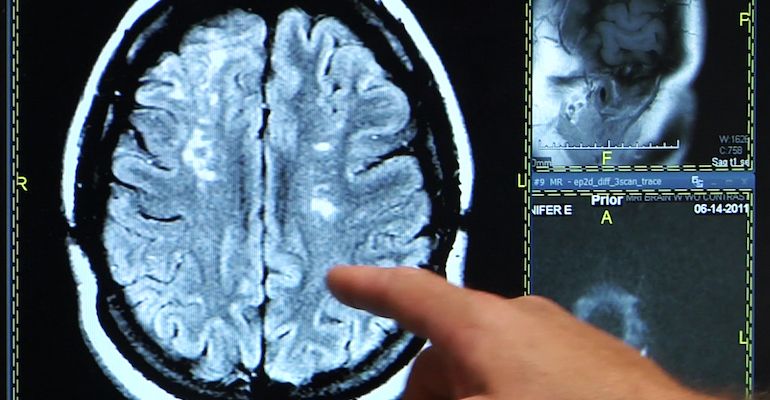 41 de unități medicale vor face tromboliză intravenoasă. Spitalul din Zalău, inclus pe lista celor care vor efectua procedura