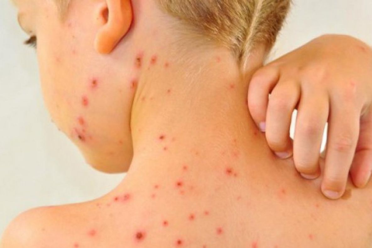 Peste 100 de cazuri de rujeolă confirmate în ultima săptămână! Sălaj, 11 noi îmbolnăviri