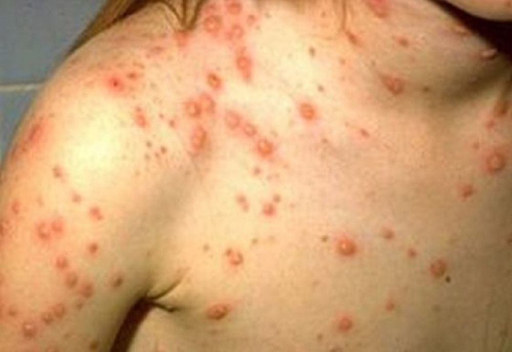 Nu mai scăpăm de rujeolă! Sălajul este în topul județelor cu cele mai multe îmbolnăviri