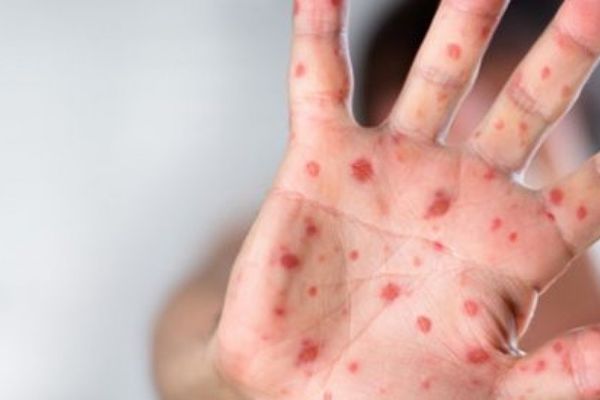 Creşte numărul cazurilor de rujeolă în Sălaj